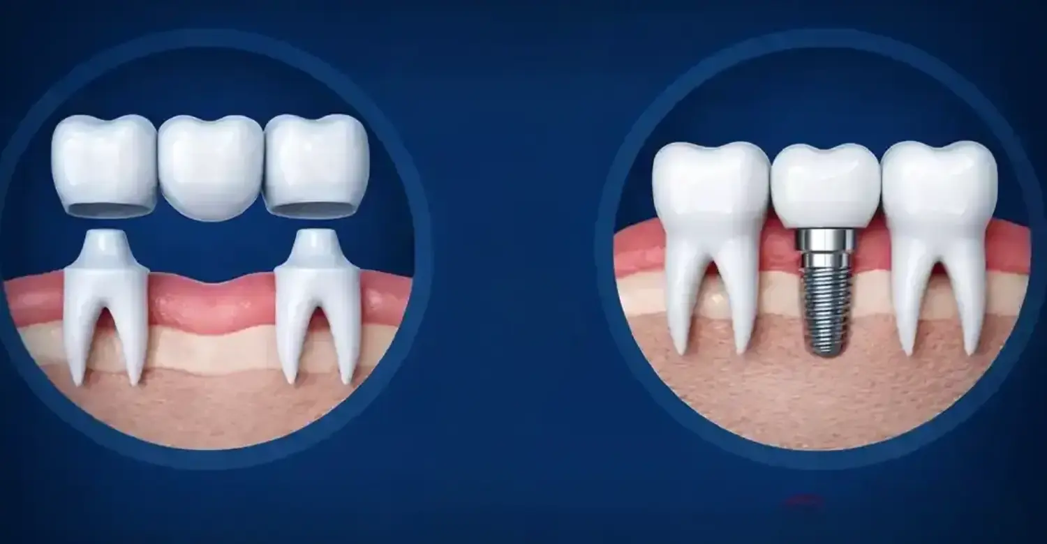 Dental Implant Bridges 2
